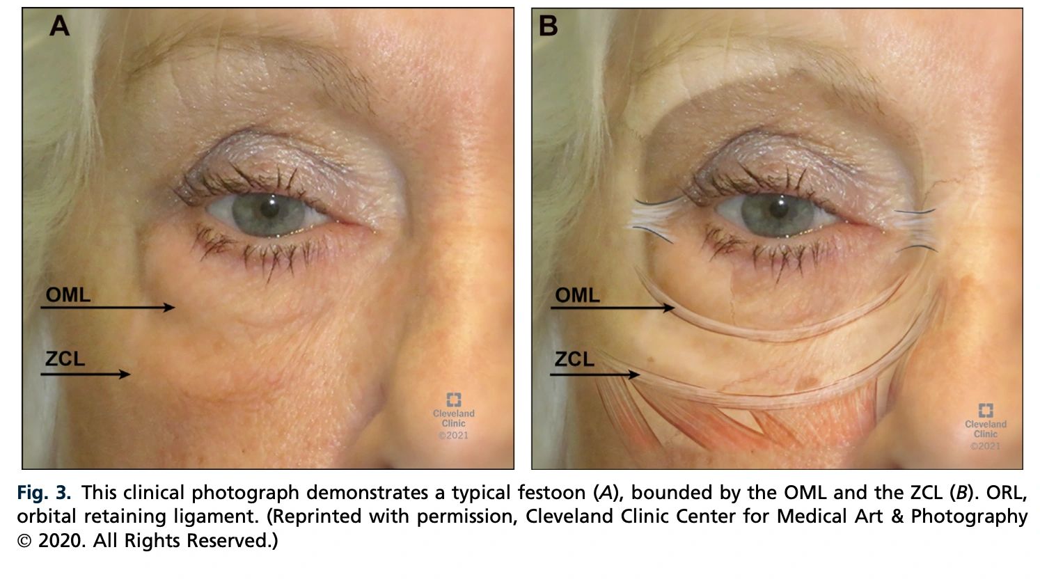 Treatment Options for Lower Eyelid Festoons